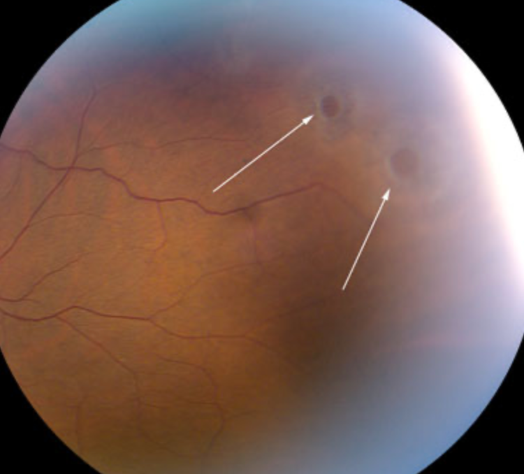 Retinal holes