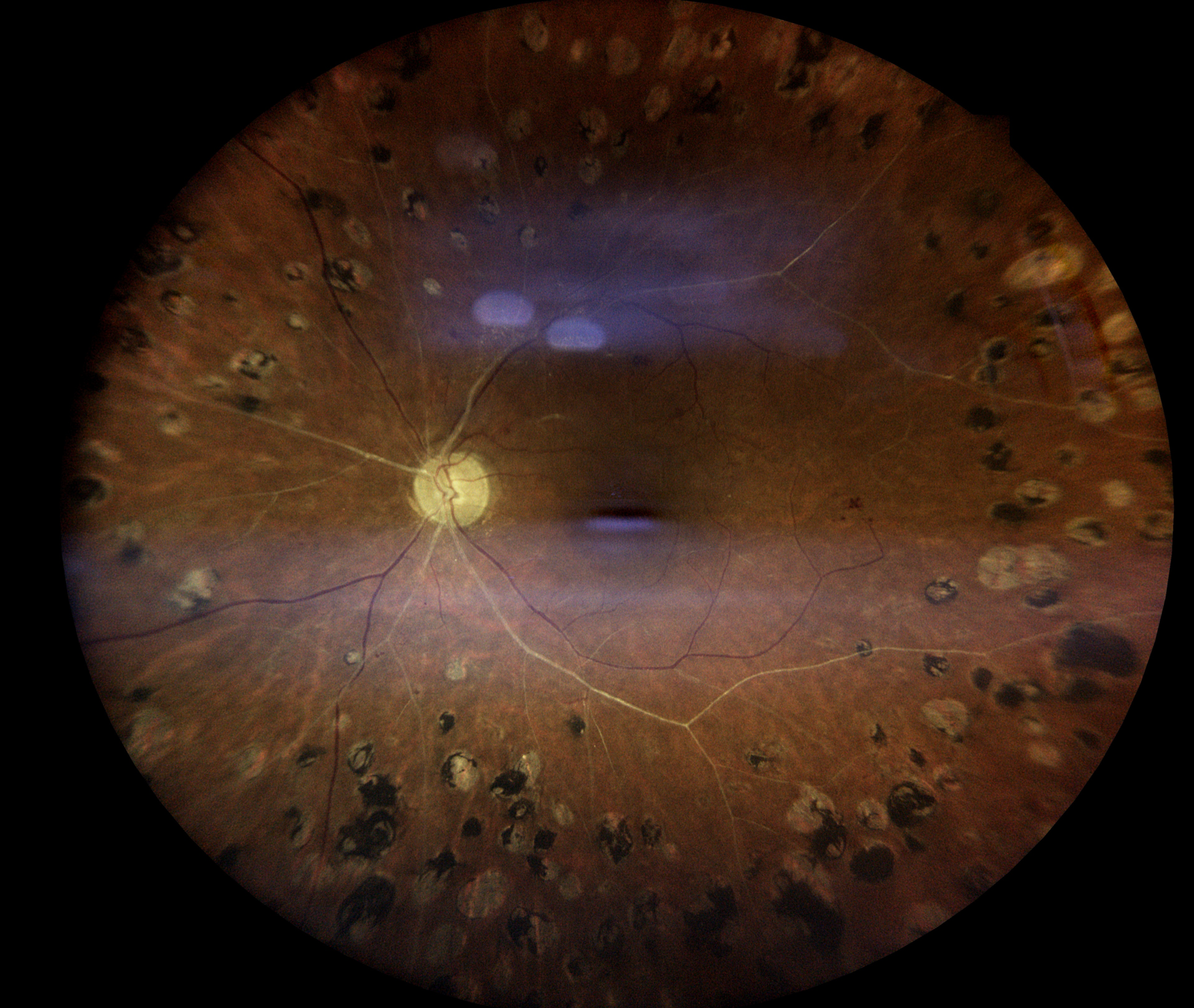 Retinal Laser Therapy