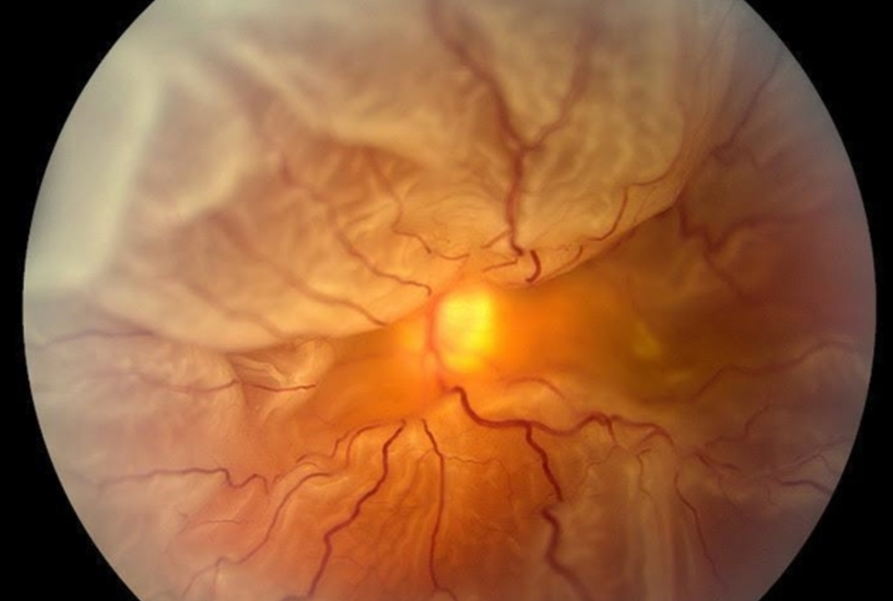 Retinal detachment