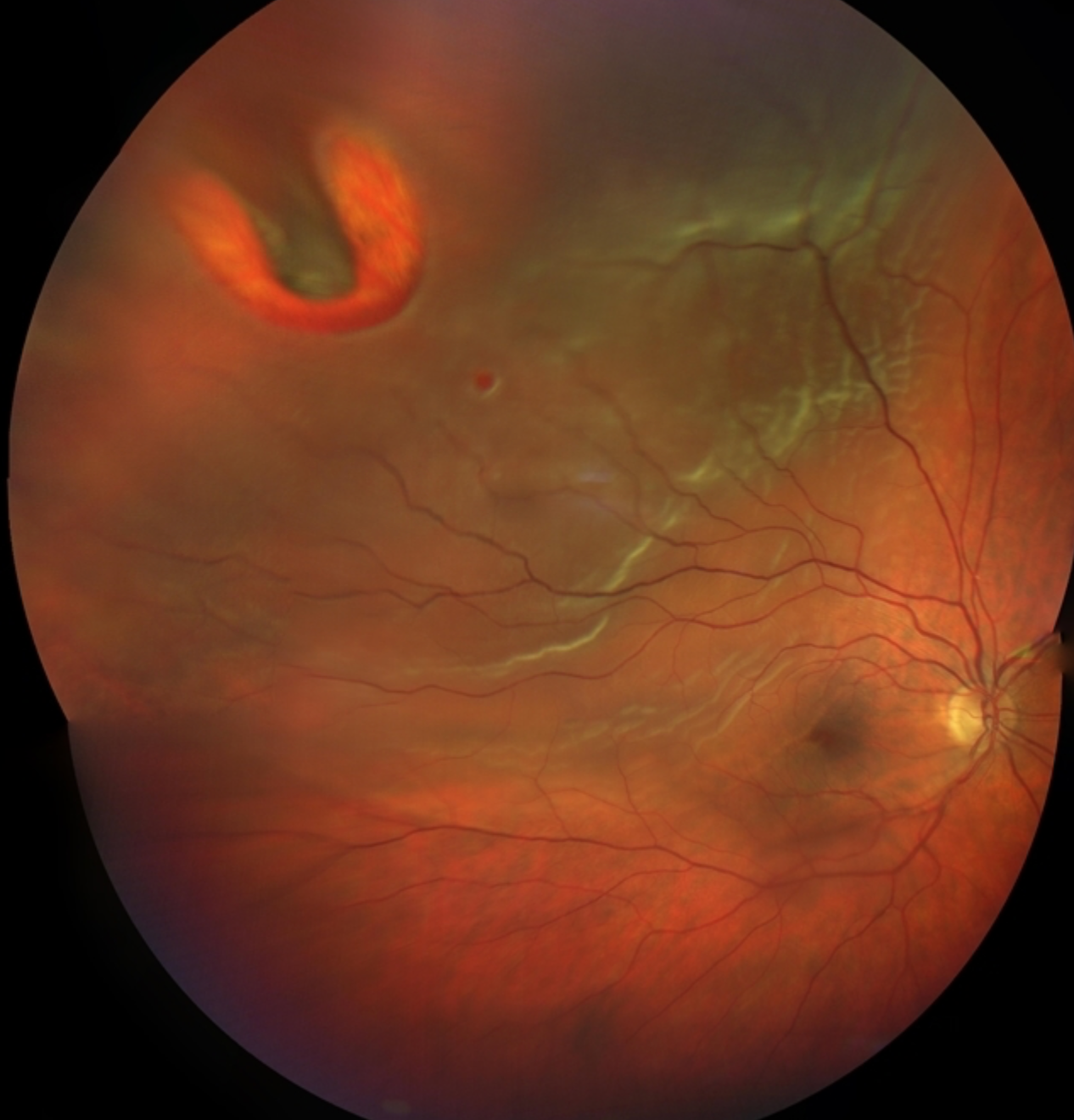 Retinal detachment