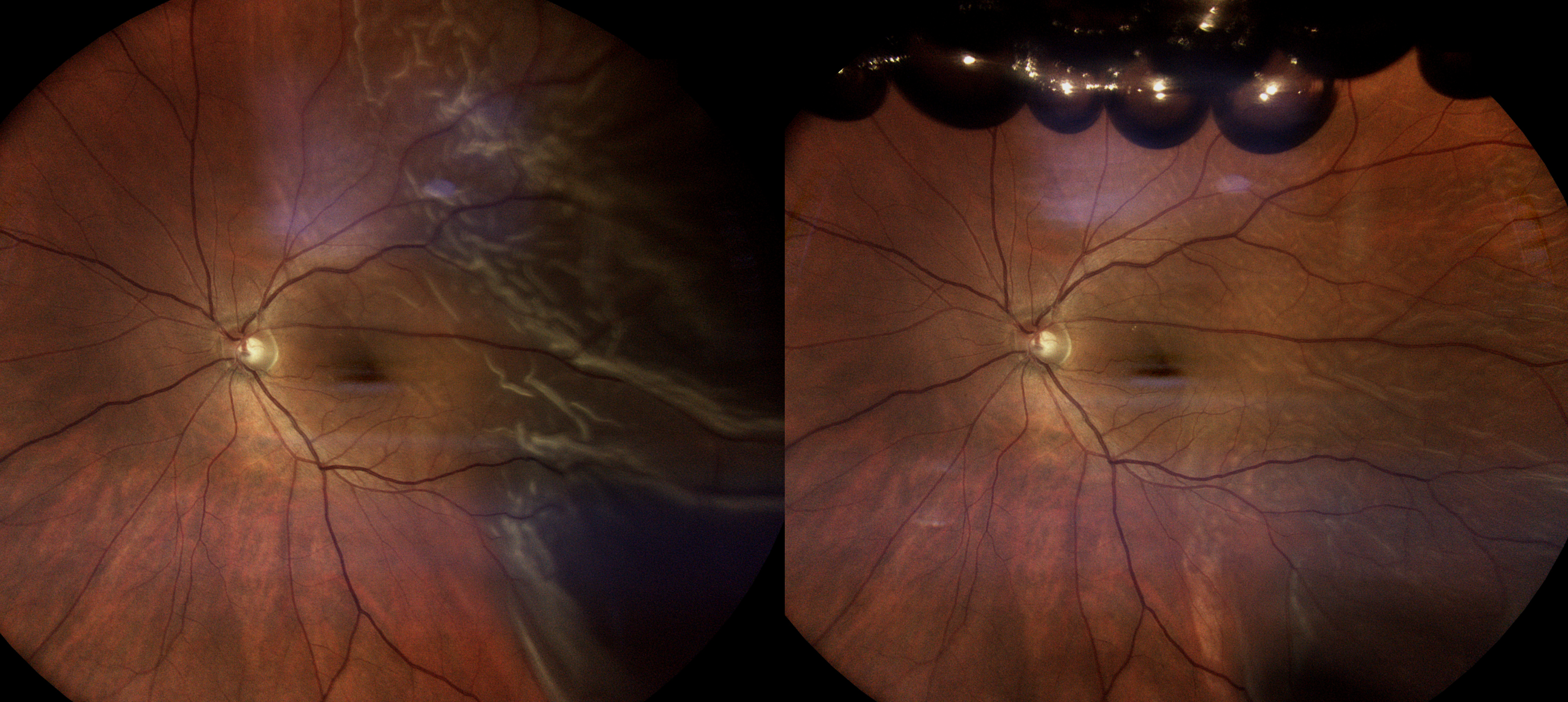 Pneumatic Retinopexy