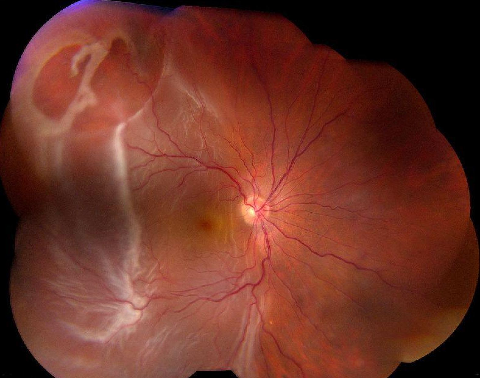 Retinal detachment