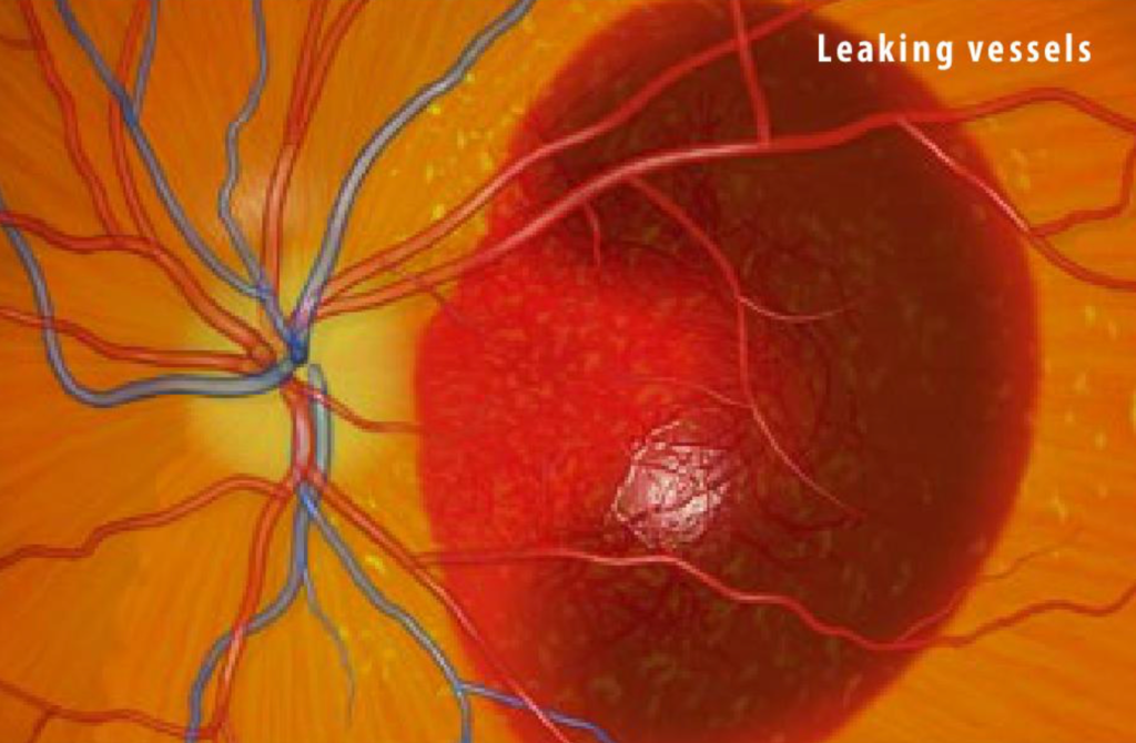 Blood leaking due to macular degeneration