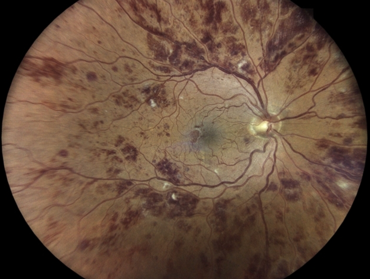 Retinal vein occlusion