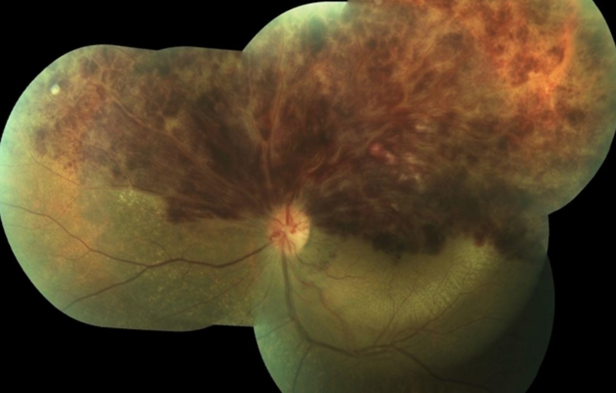 Retinal Vein Occlusion