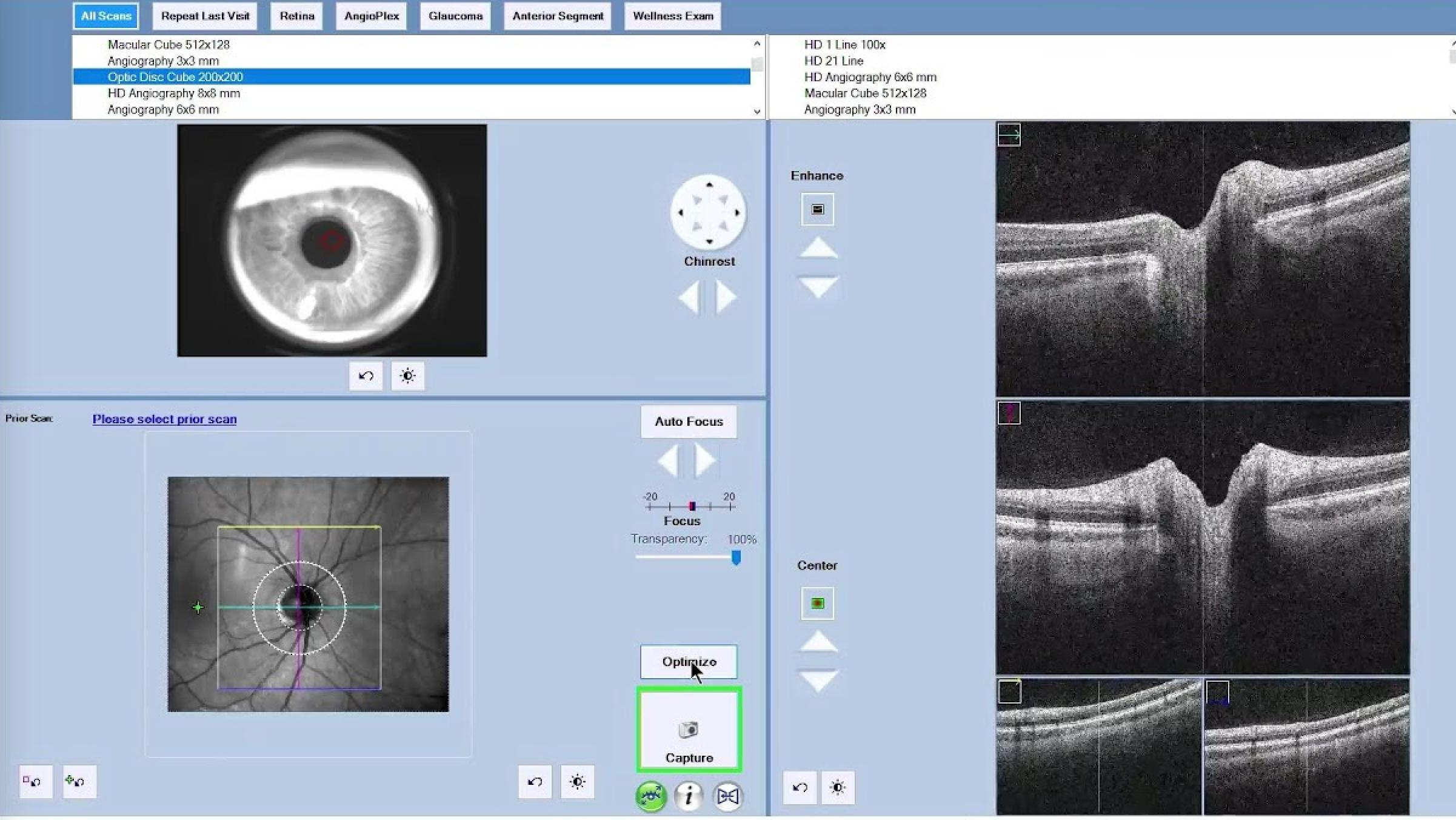 Optical Coherence Tomography