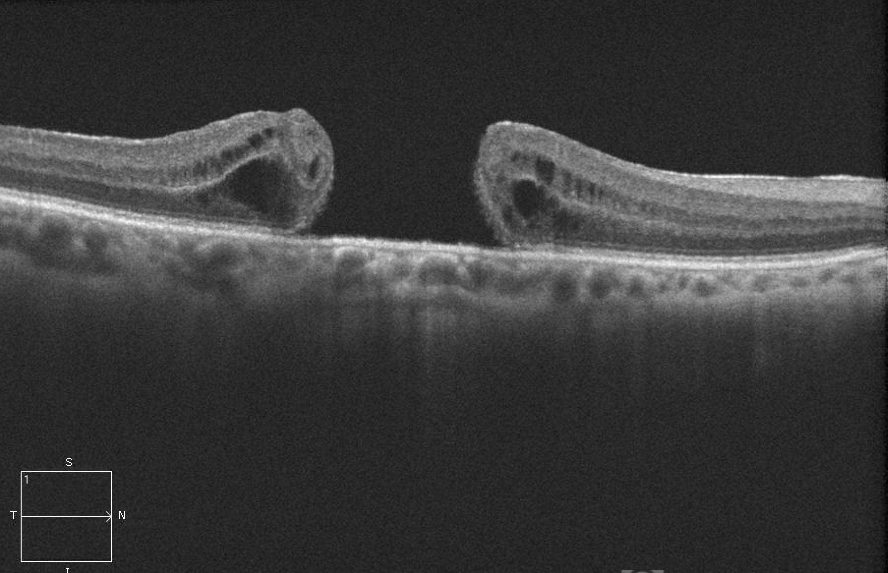 Macular Hole