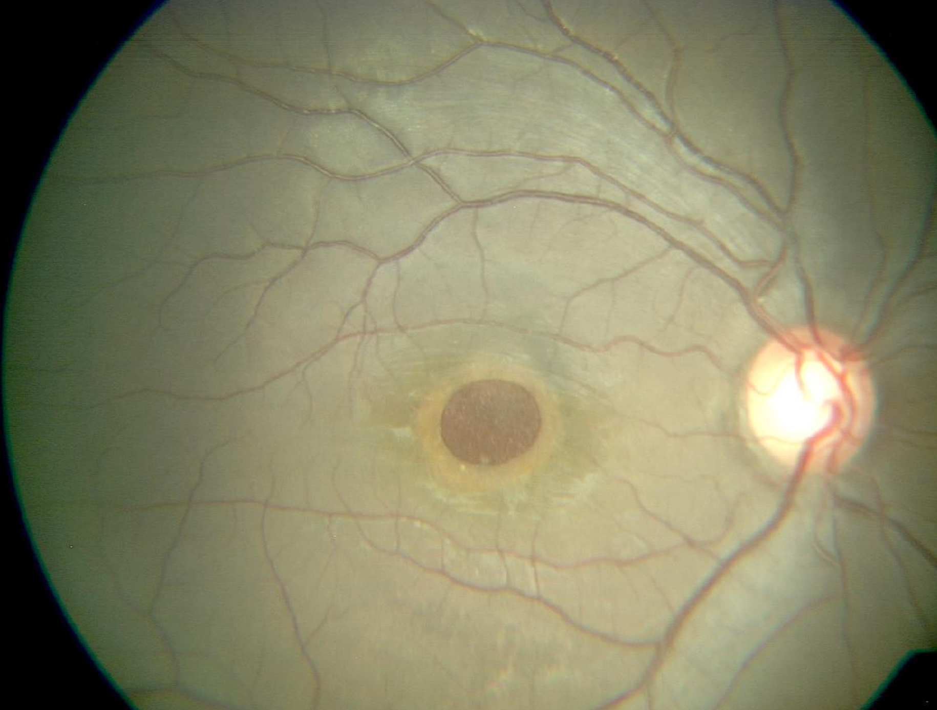 Macular Hole