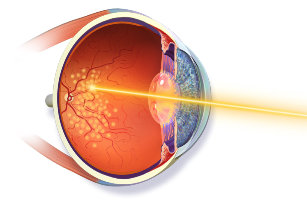 Retinal Laser Treatment