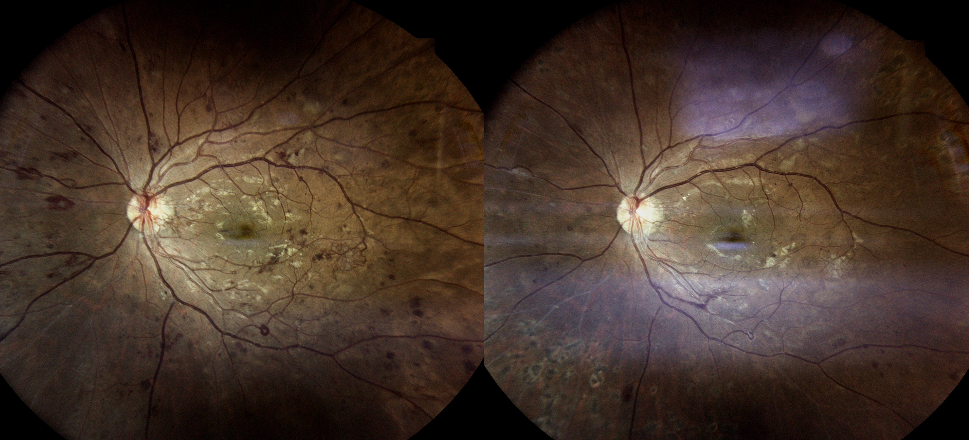 Diabetic Retinopathy