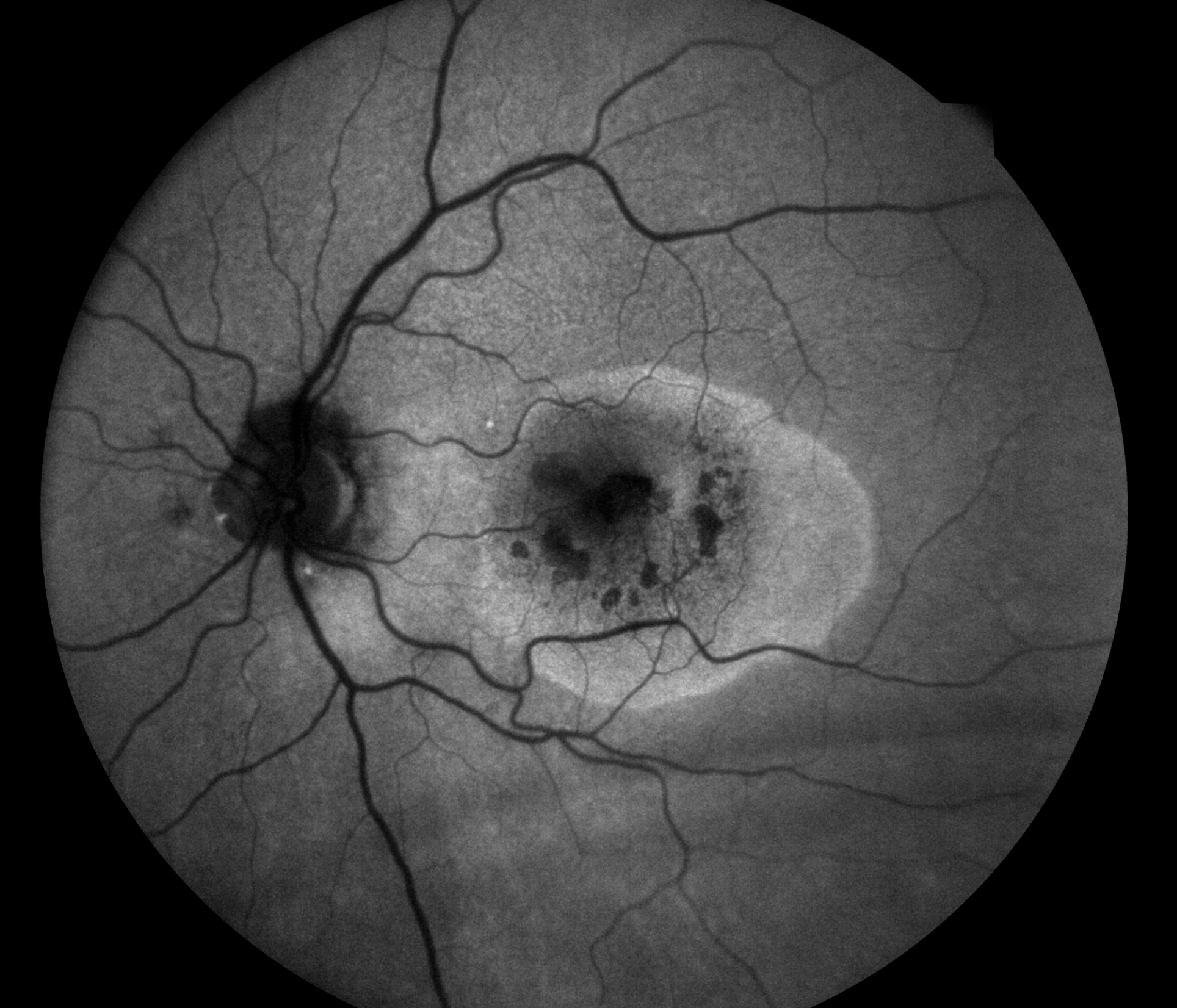 Fundus Autofluorescence