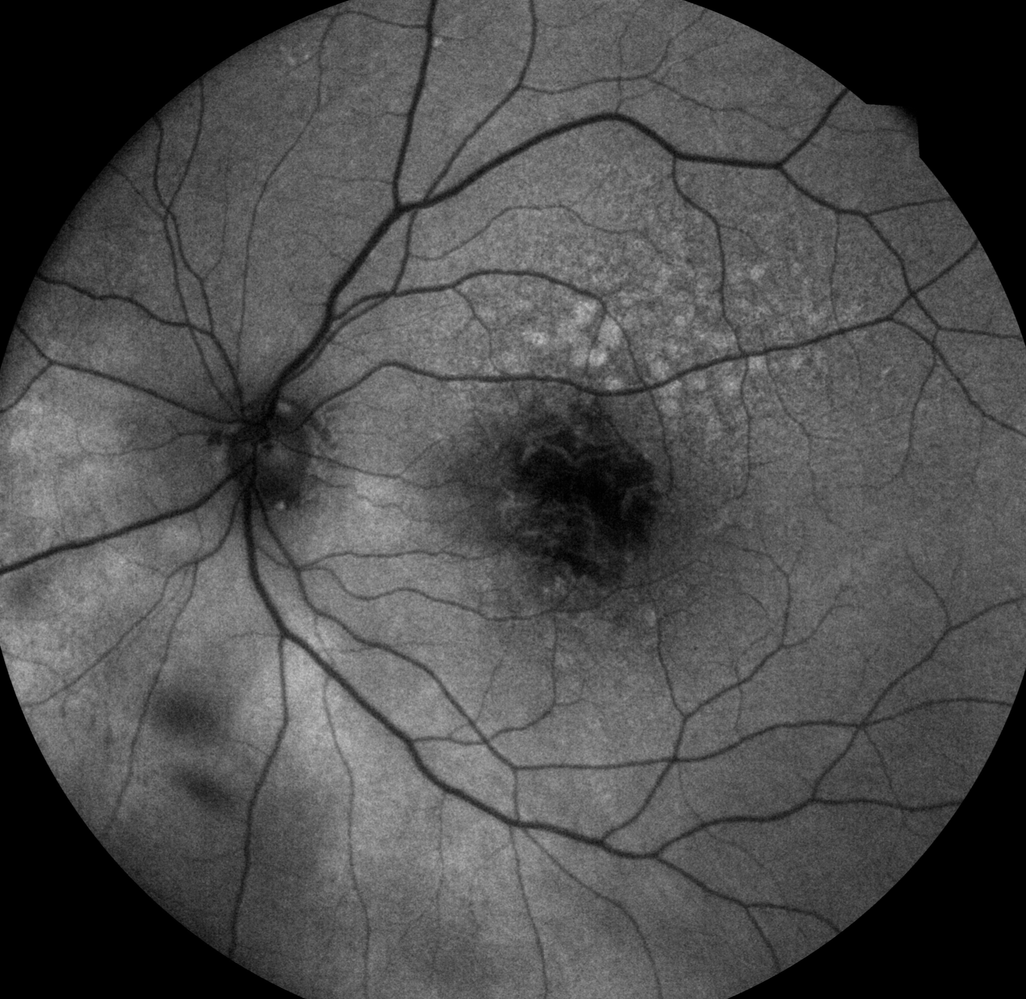 Fundus Autofluorescence