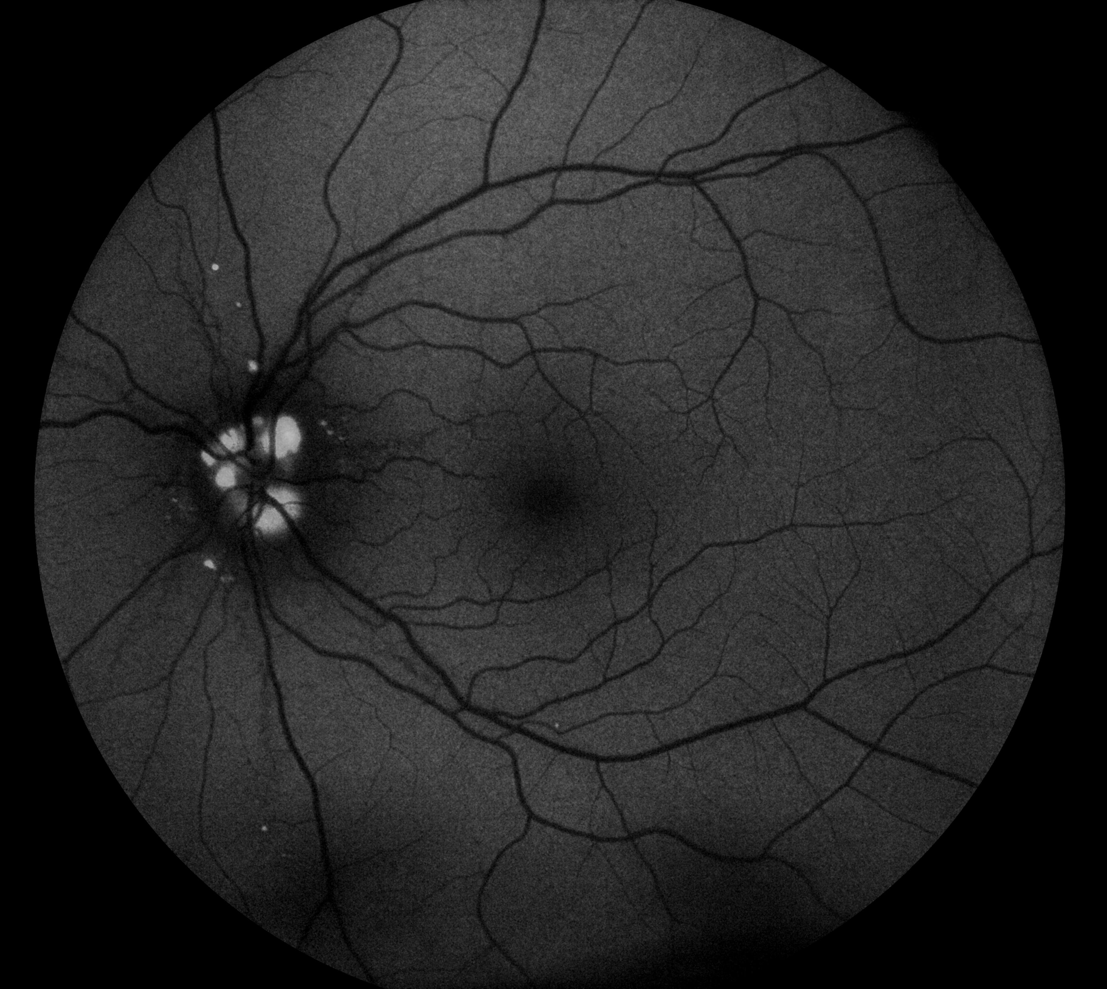 Fundus Autofluorescence