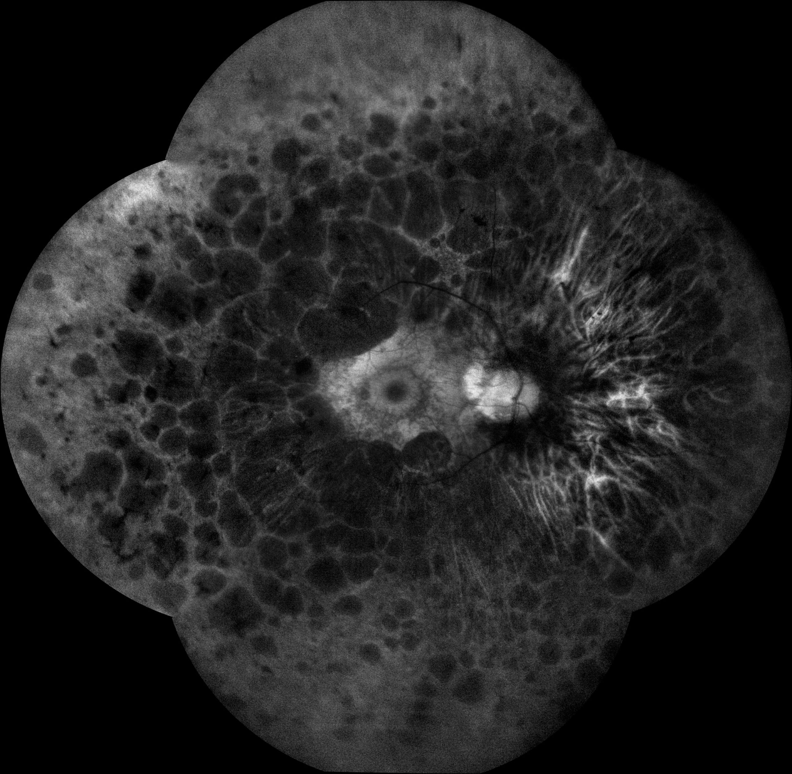 Fundus Autofluorescence