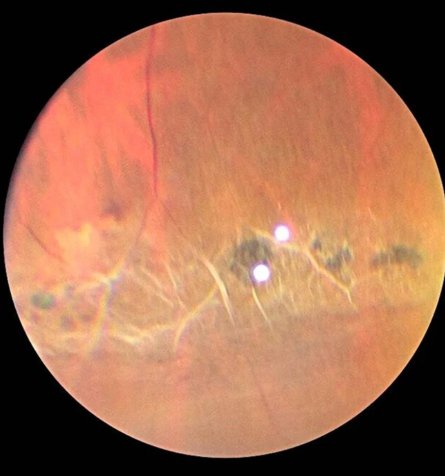 Lattice Degeneration of the Retina