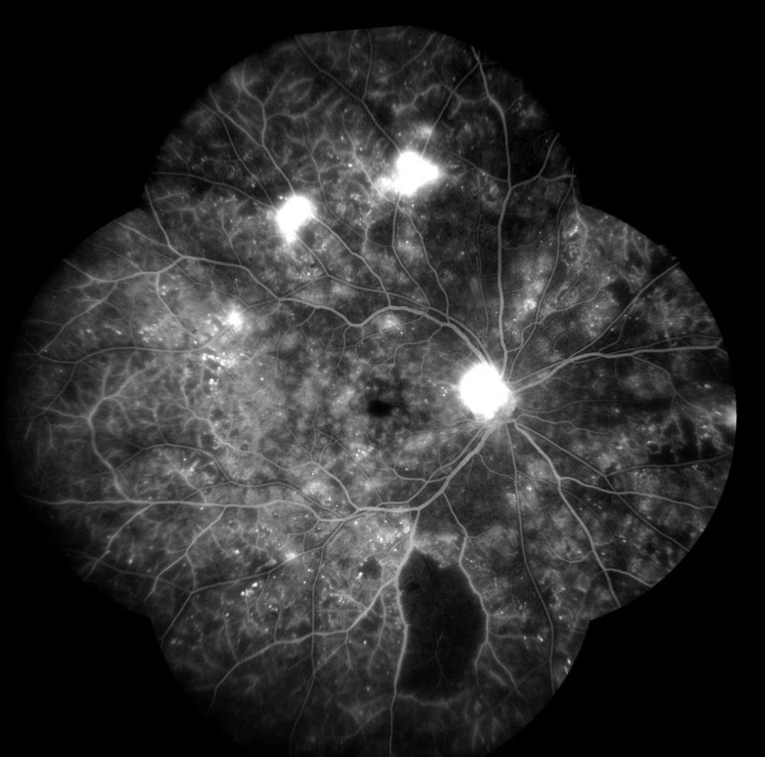 Fluorescein Angiography