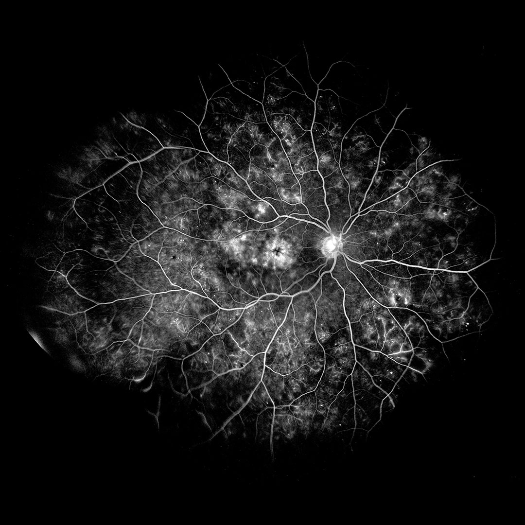 Fluorescein Angiography