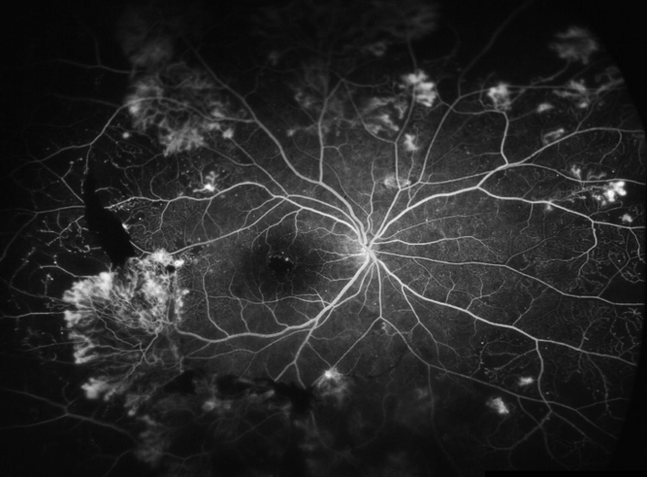 Fluorescein Angiography