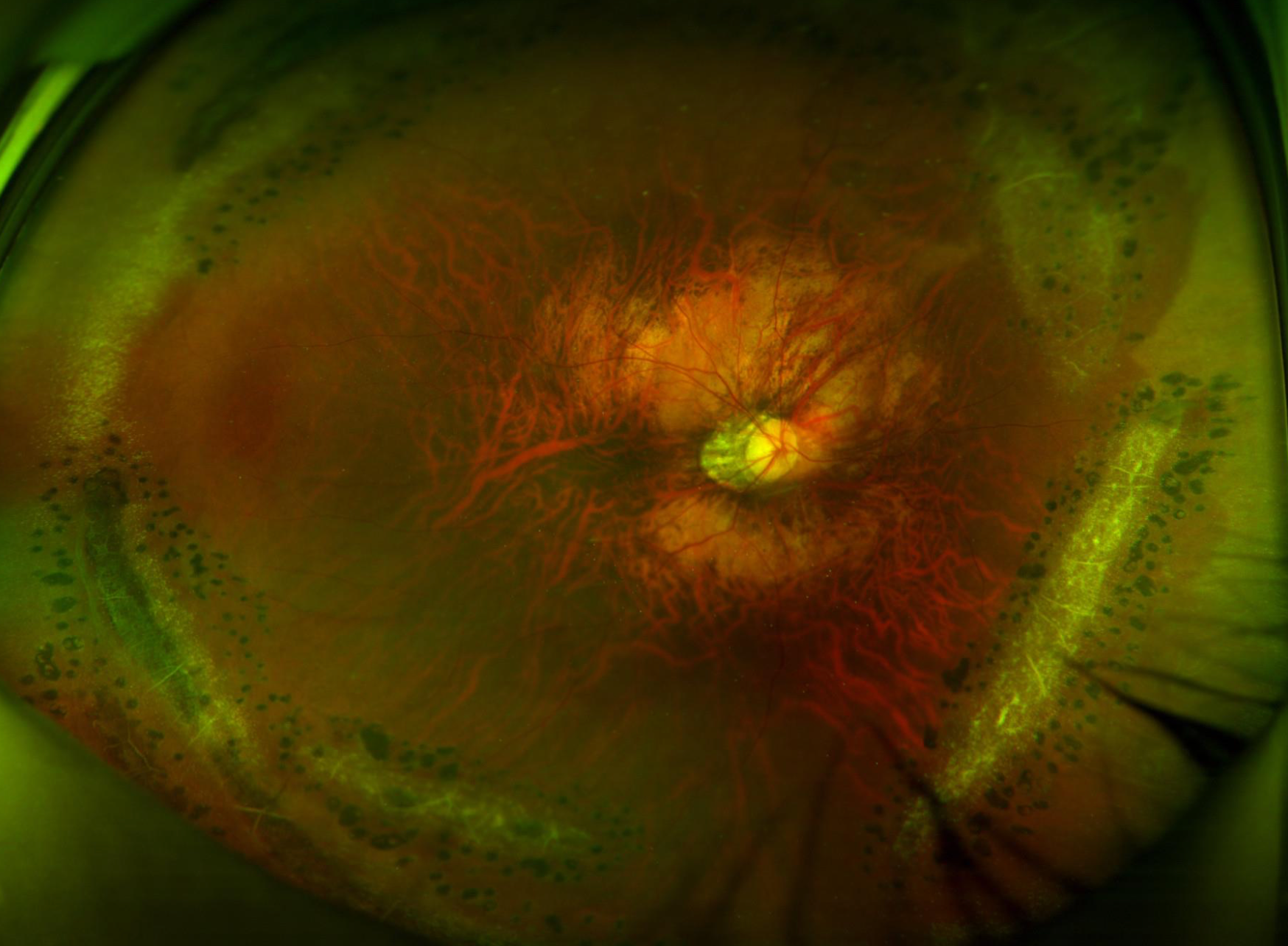 Lattice Degeneration of the Retina