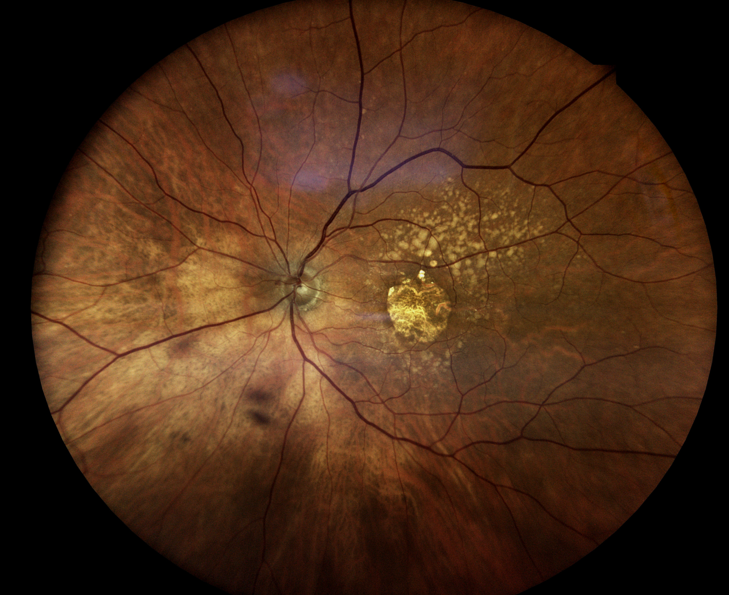 Dry Macular Degeneration