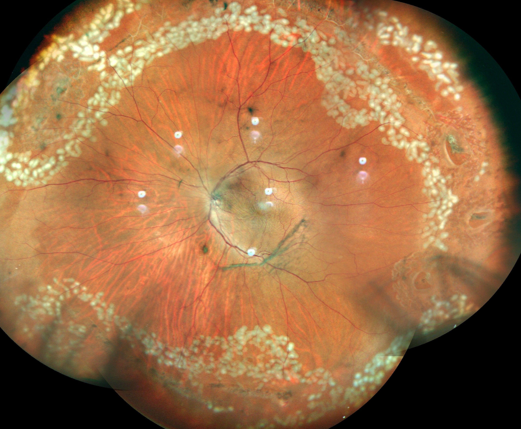 Lattice Degeneration of the Retina