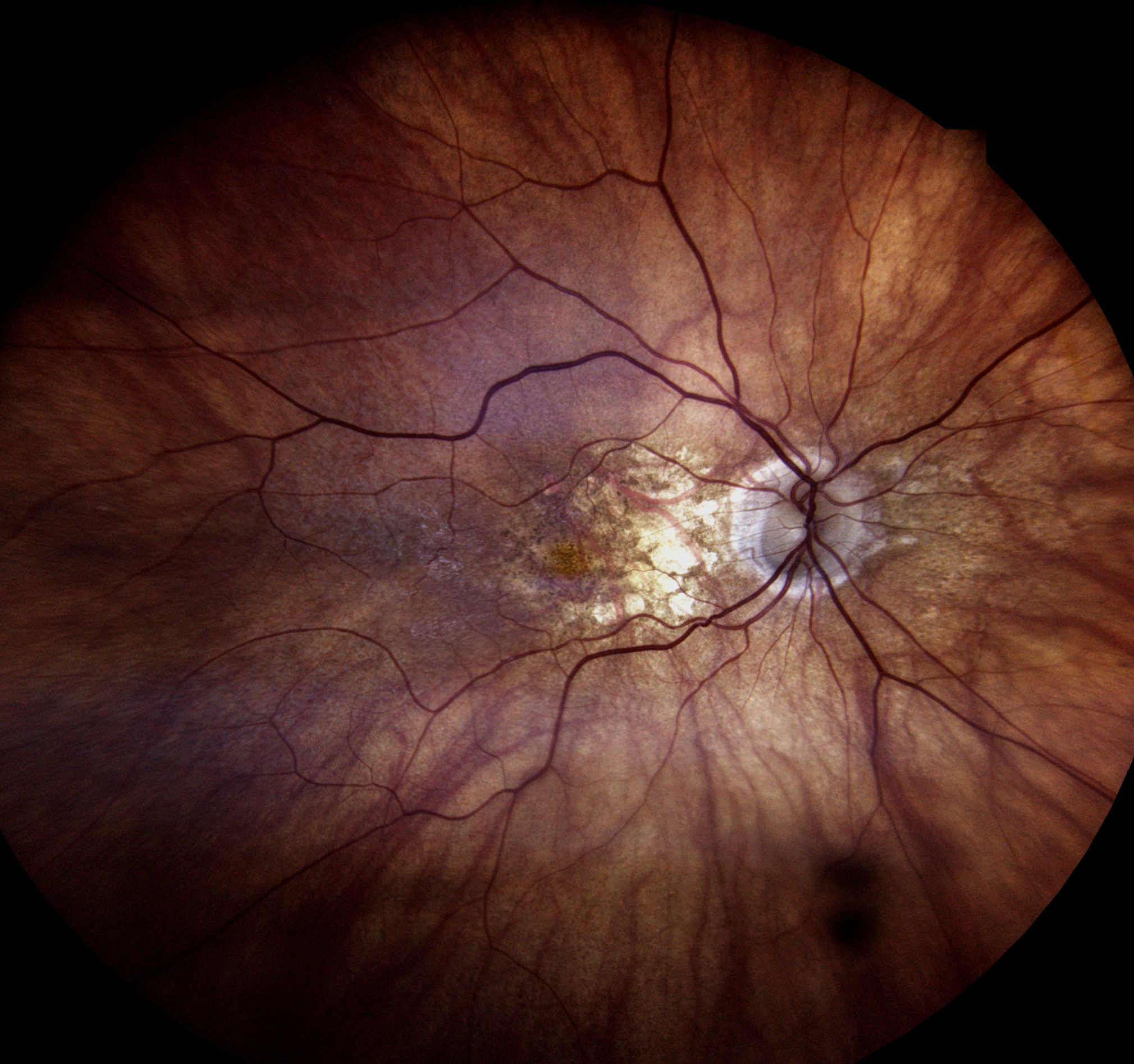 Dry Macular Degeneration