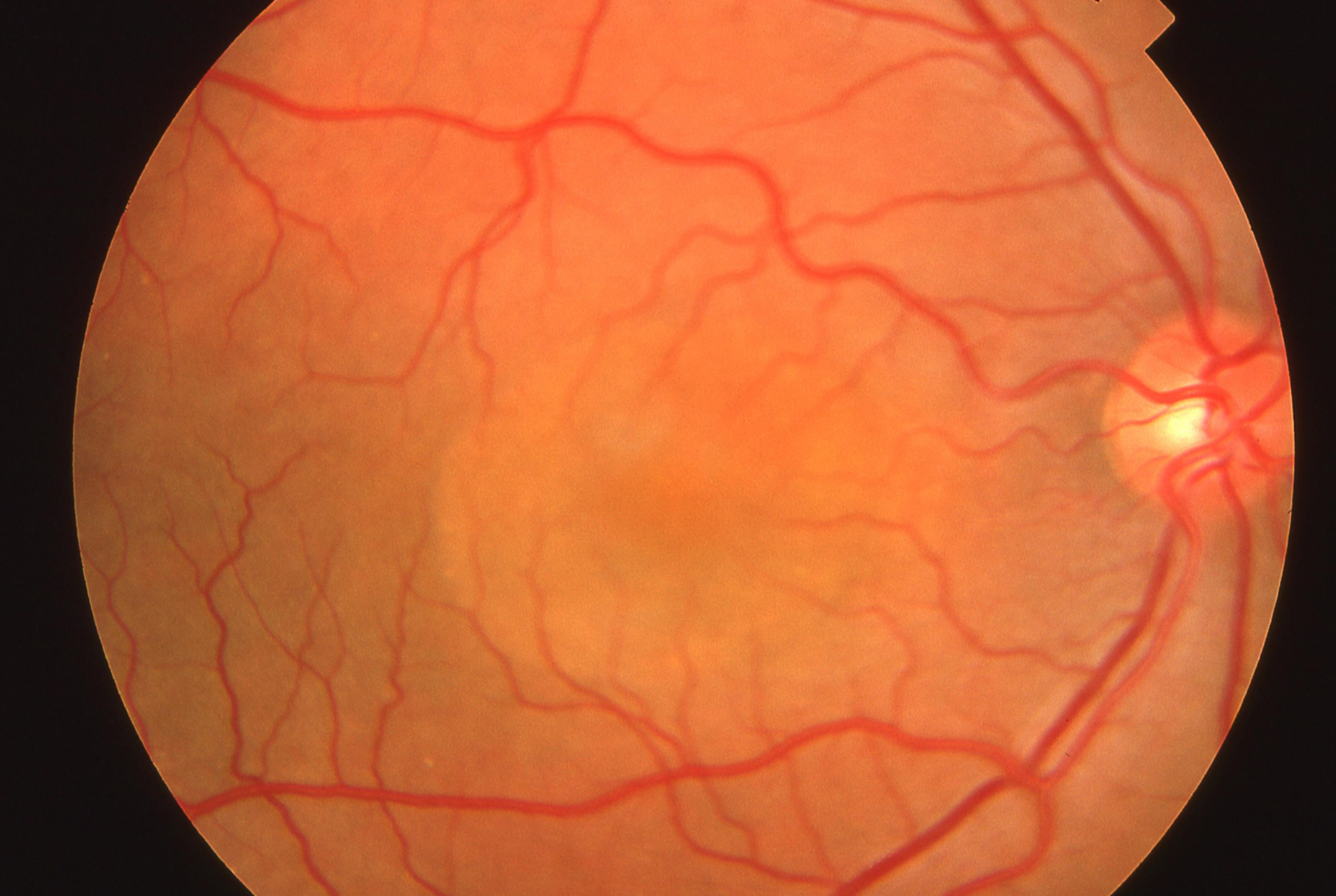 Central Serous Retinopathy