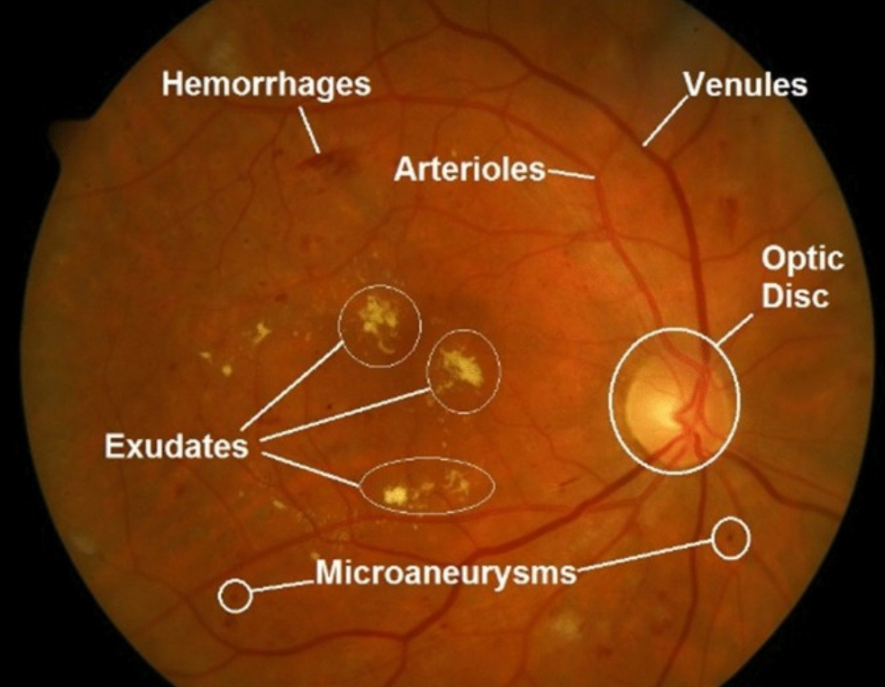 Diabetic Macular Edema