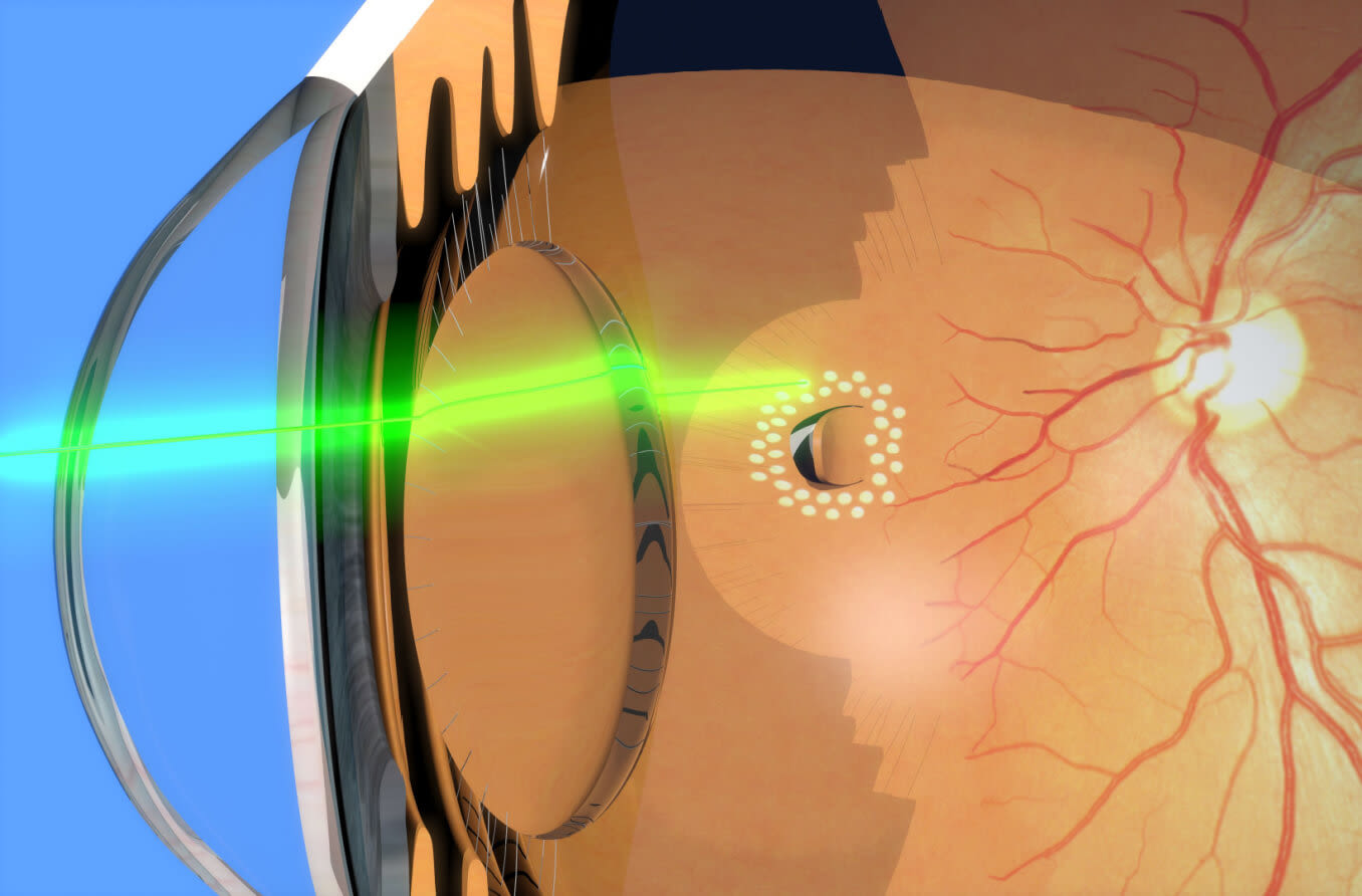 Retinal Laser Treatment