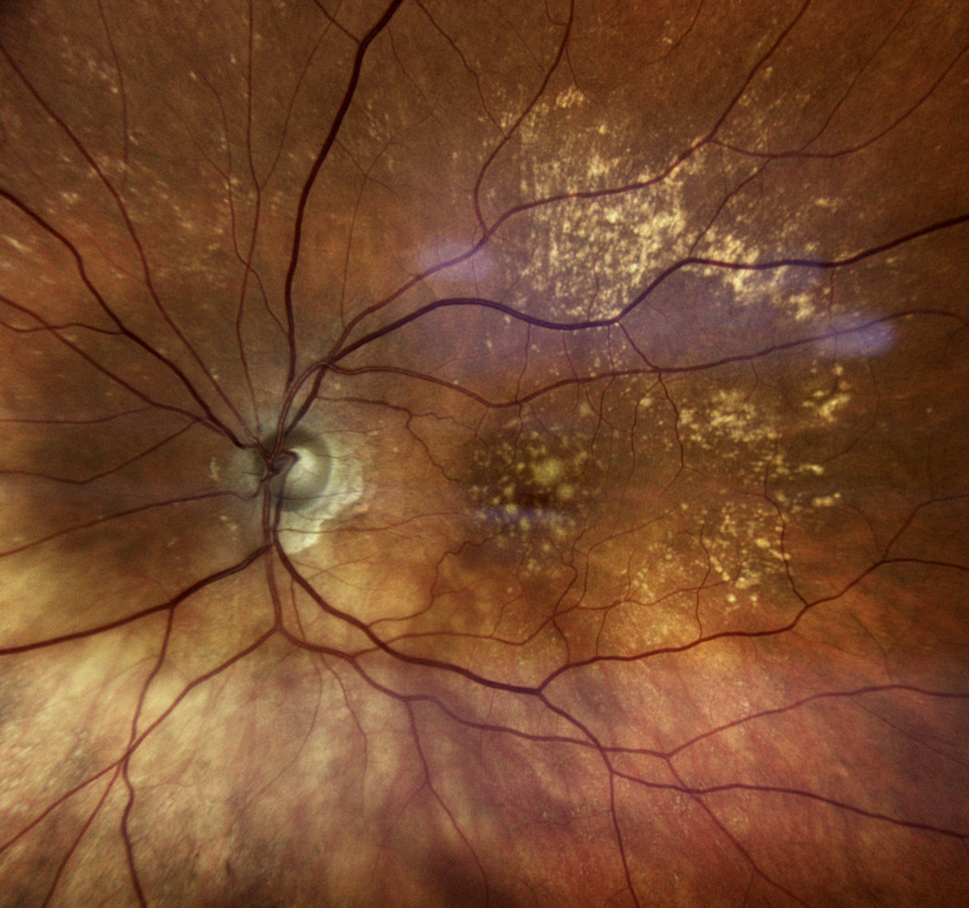 Dry Macular Degeneration