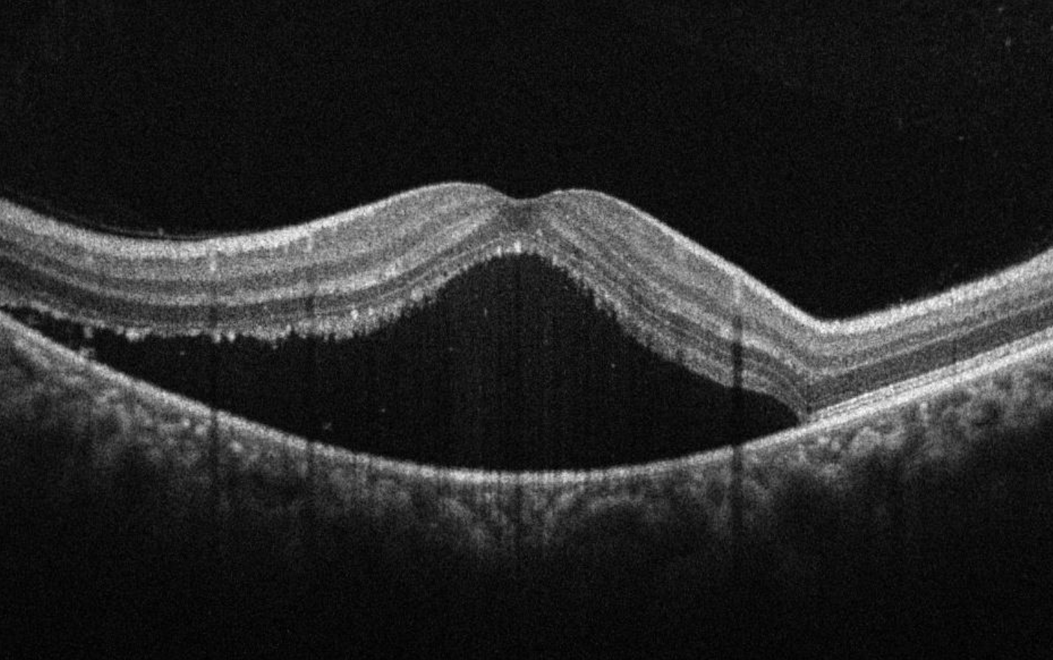 Central Serous Retinopathy