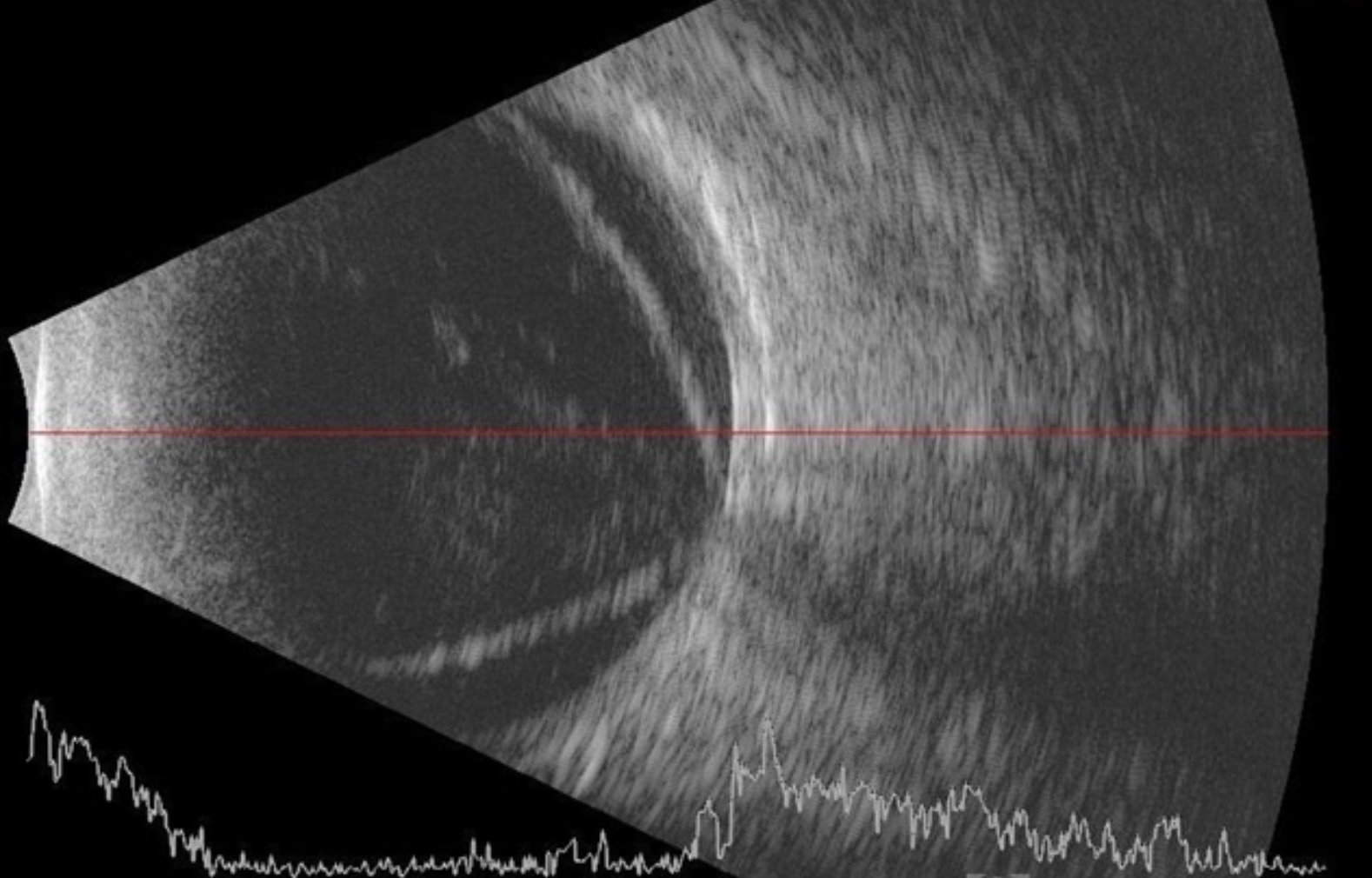 Ophthlamic Ultrasonography