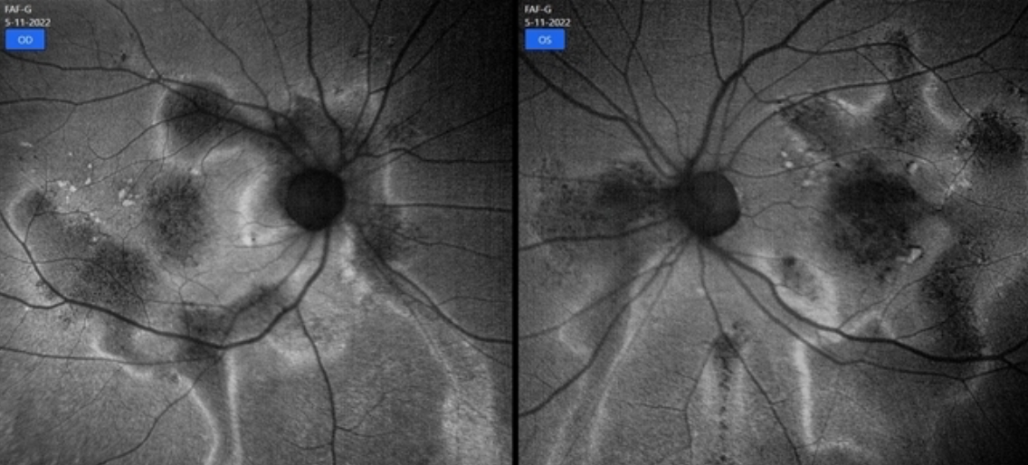 Central Serous Retinopathy