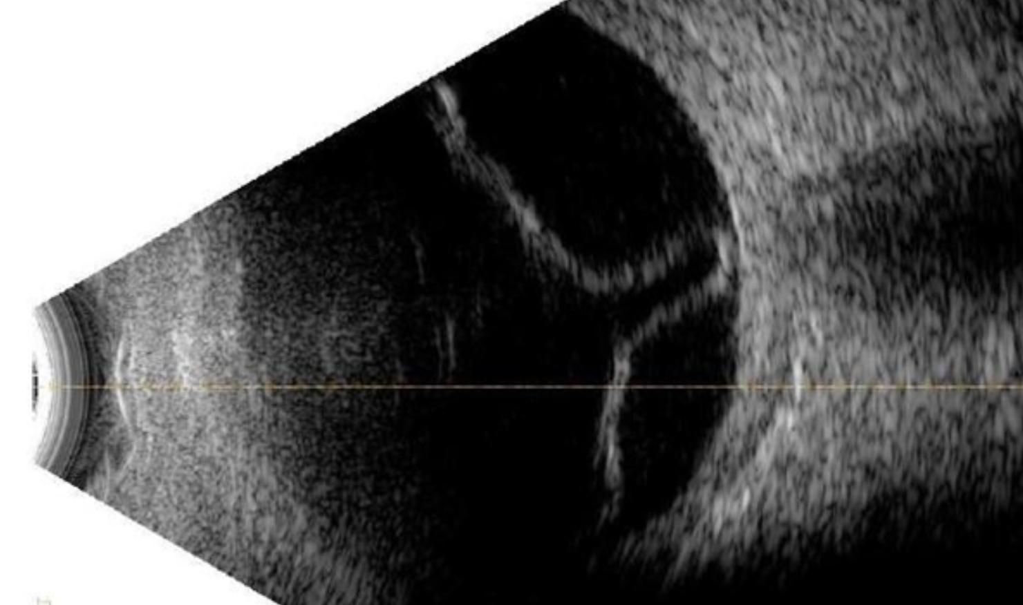 Ophthlamic Ultrasonography