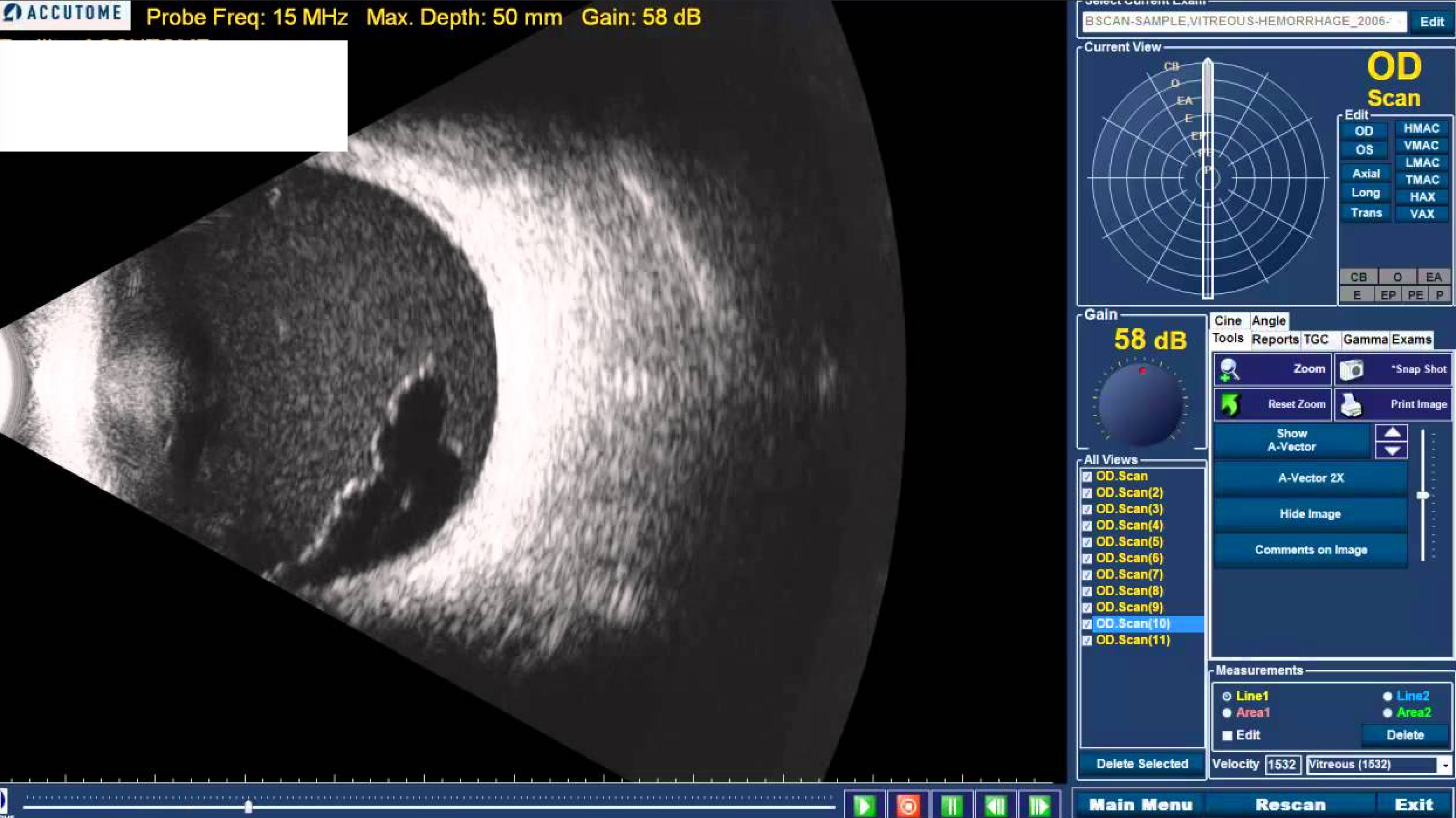 Ophthlamic Ultrasonography