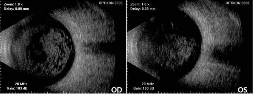 Ophthlamic Ultrasonography