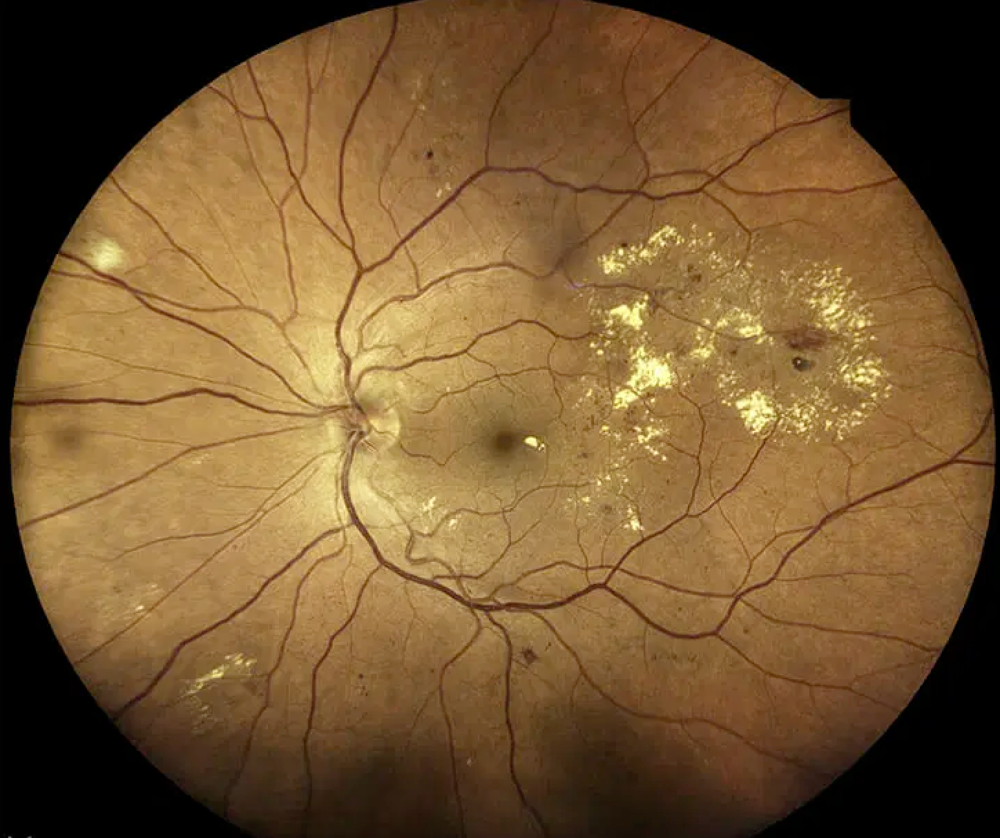 Diabetic Macular Edema