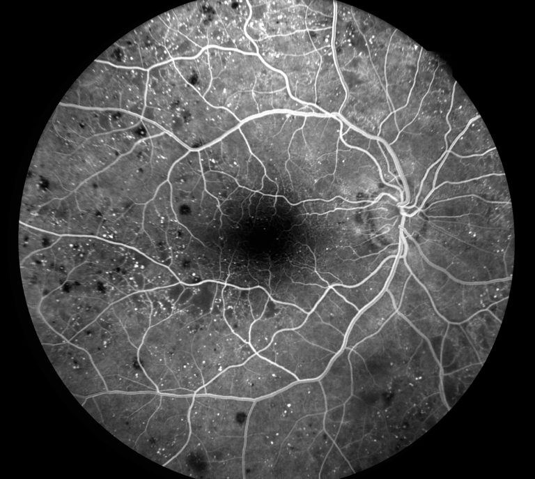 Fluorescein Angiography