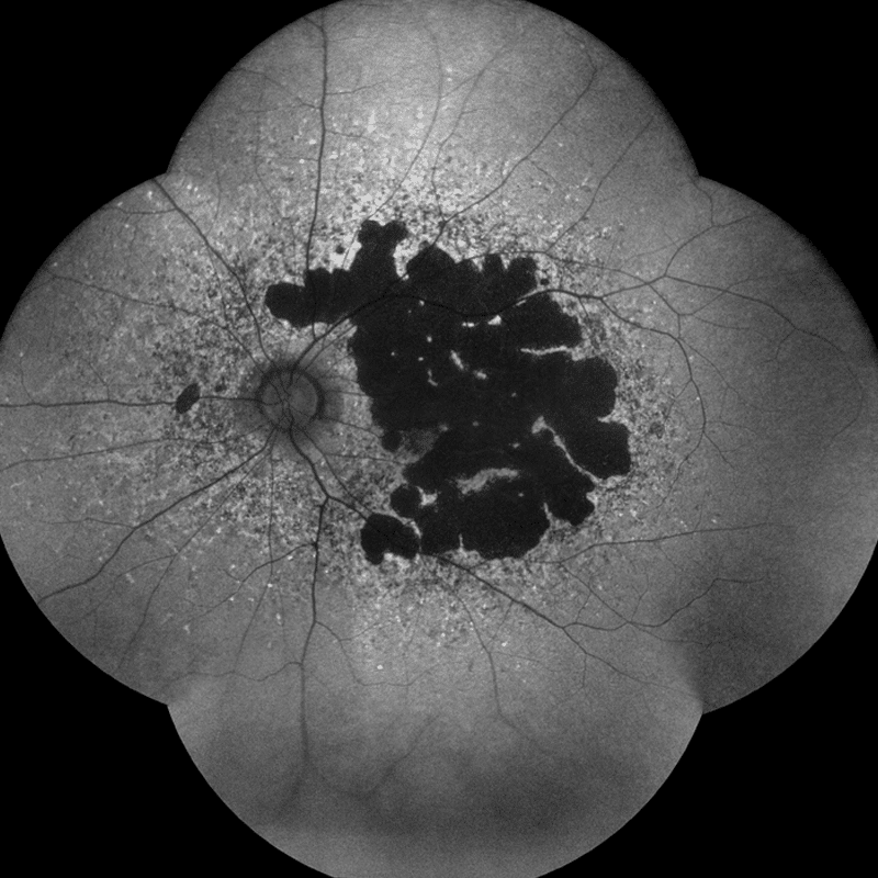 Fundus Autofluorescence