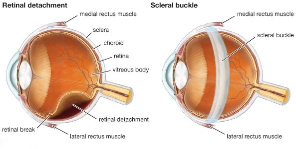 Scleral Buckle Surgery