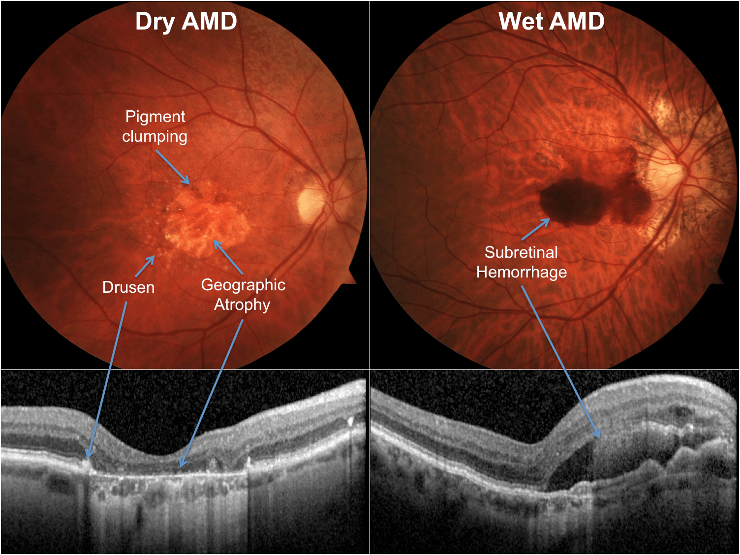 Dry macular degeneration