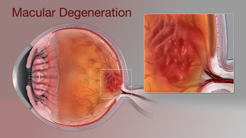 Macular degeneration