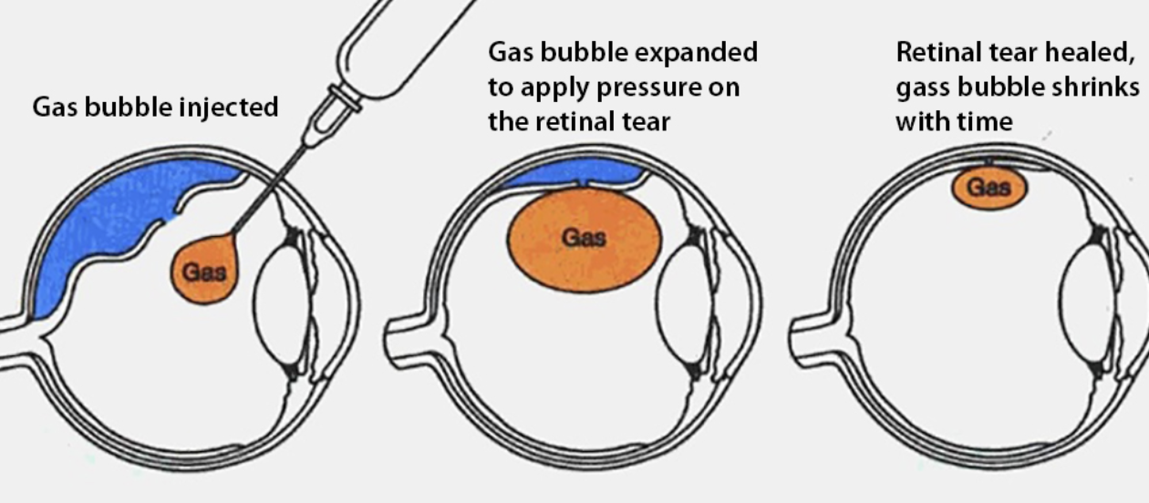 Pneumatic Retinopexy