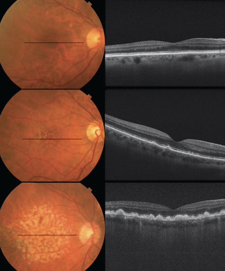 Dry macular degeneration