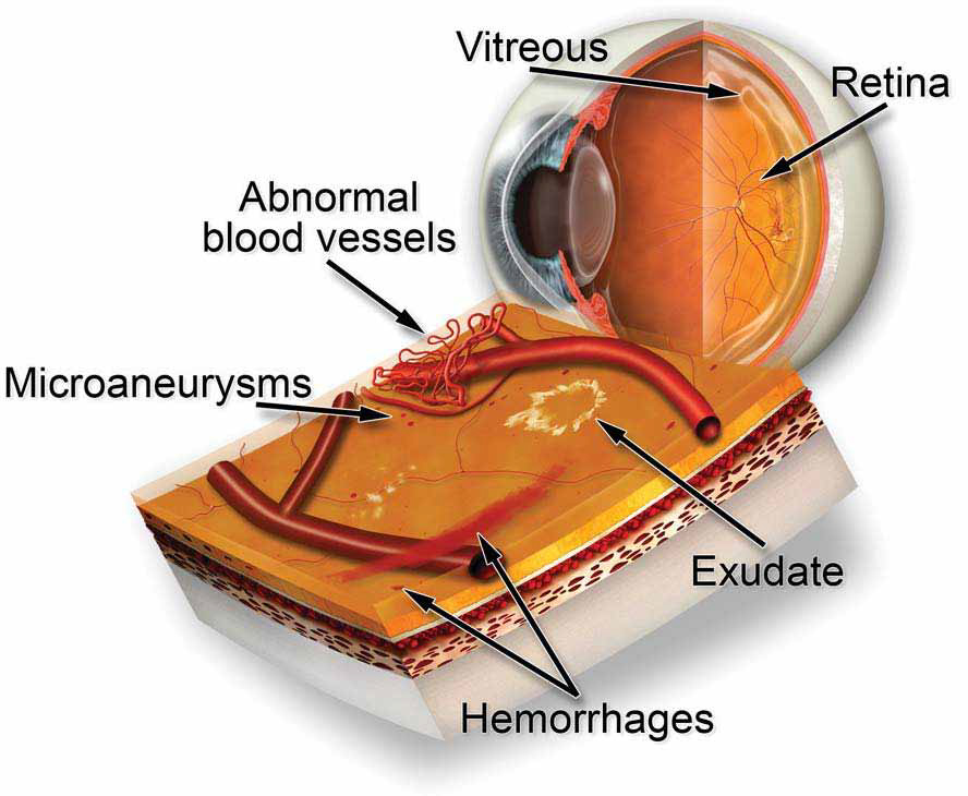 Diabetic retinopathy