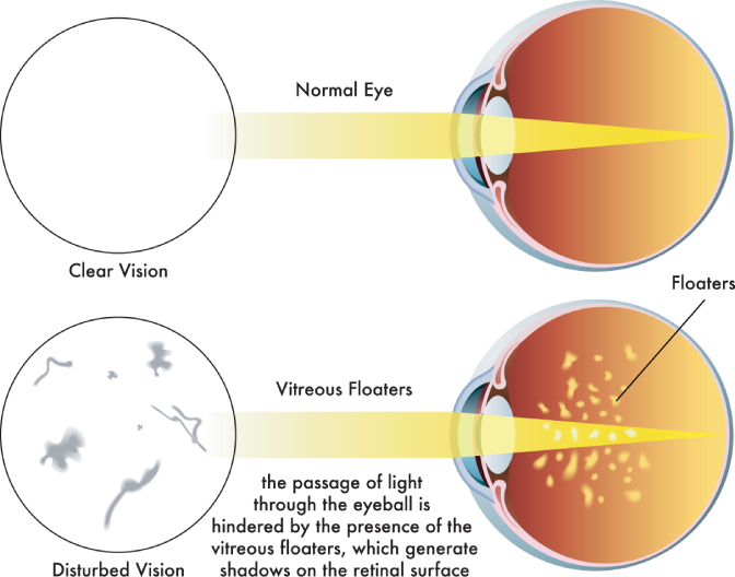 Normal eye vs flashes and floaters