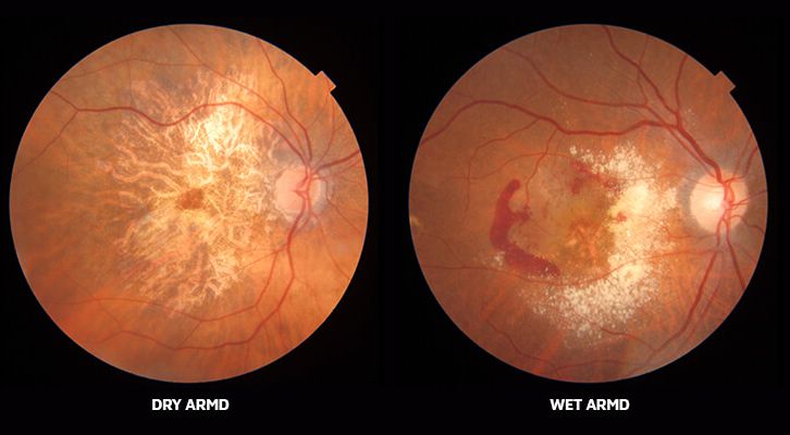 Macular degeneration