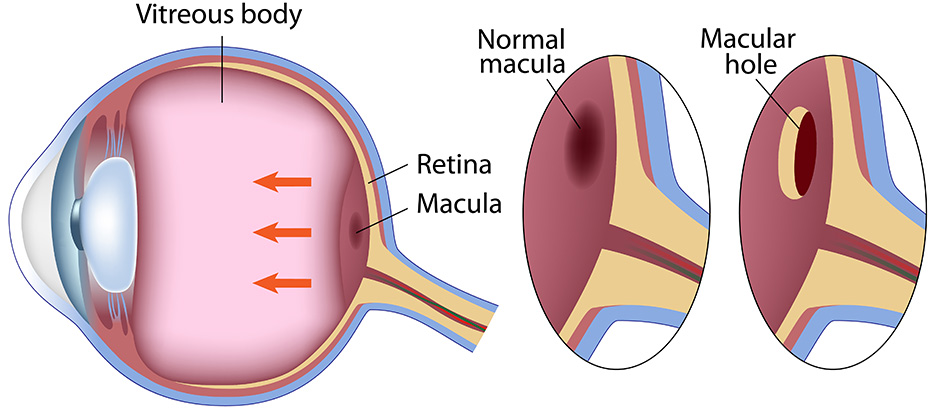 Macular Hole