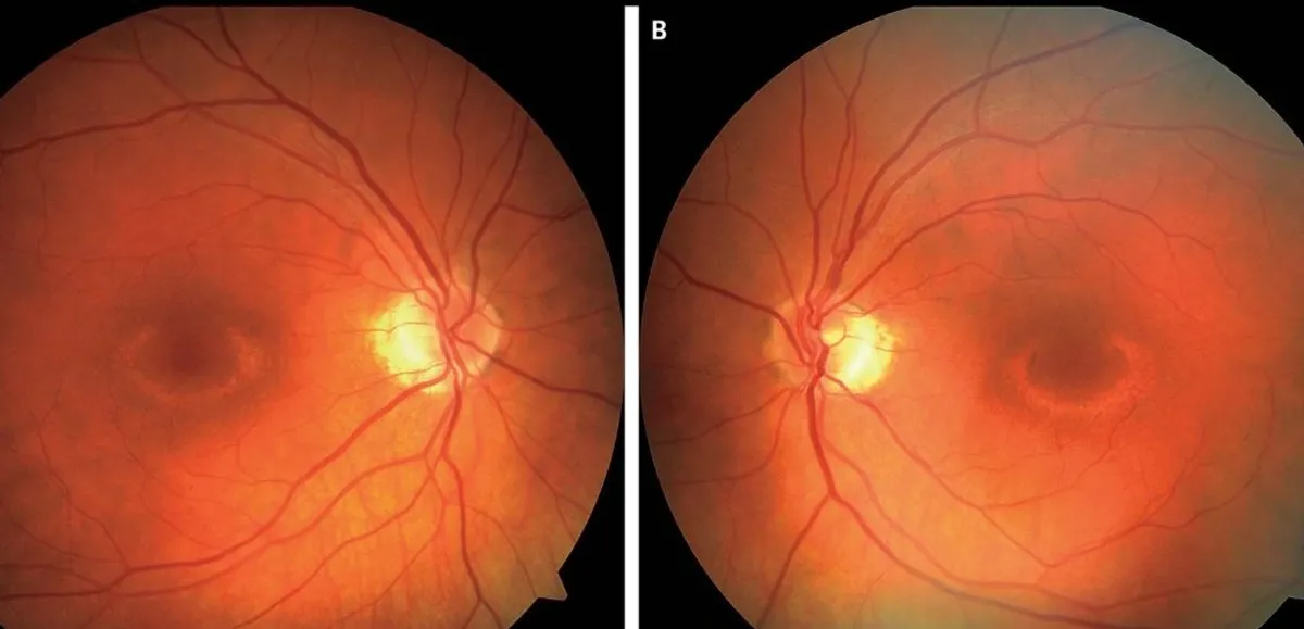 Plaquenil (hydroxychloroquine) Screening