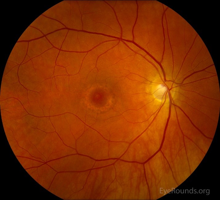 Plaquenil (hydroxychloroquine) Screening